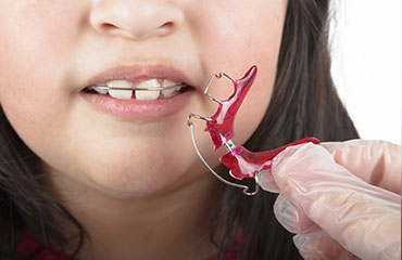 One of our goals at Tyson Family Dental your Fort Worth Texas Dentist is to provide the most conservative treatment possible in every situation. Oral appliances offer simple, non-invasive treatment for a variety of conditions. Regardless of the application, every appliance we prescribe is custom-crafted just for you.